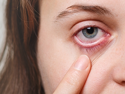 Cegueira temporria: uso de produto leva mais de 200 mulheres para hospital